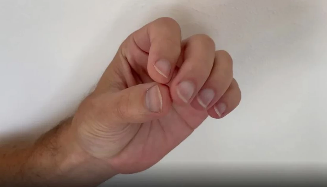 A simple technique may help with nail-biting, skin picking and other body-focused repetitive behaviors