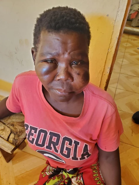 Busia: Woman seeks justice after being assaulted by husband