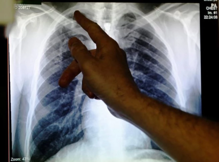 Stigma, low levels of awareness derail TB fight in Kenya