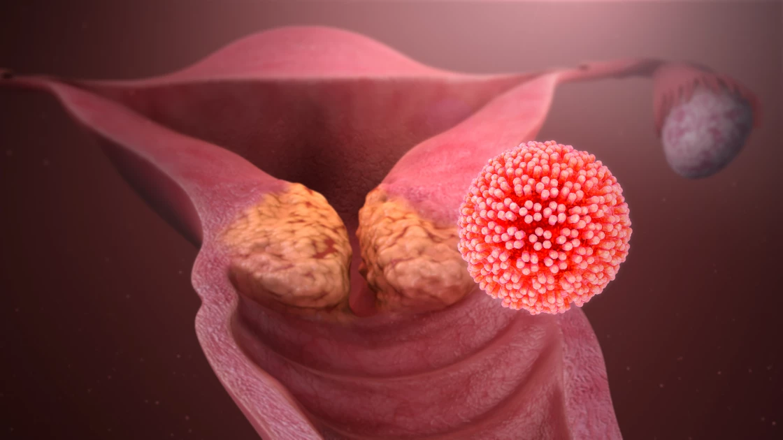 Cervical cancer: What to watch out for