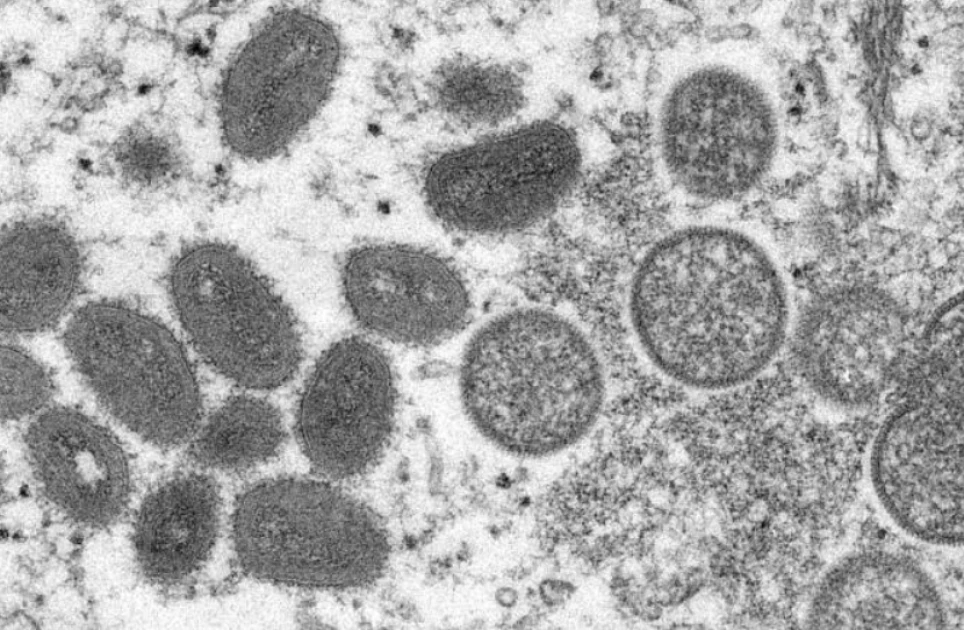 U.S health officials investigating monkeypox case