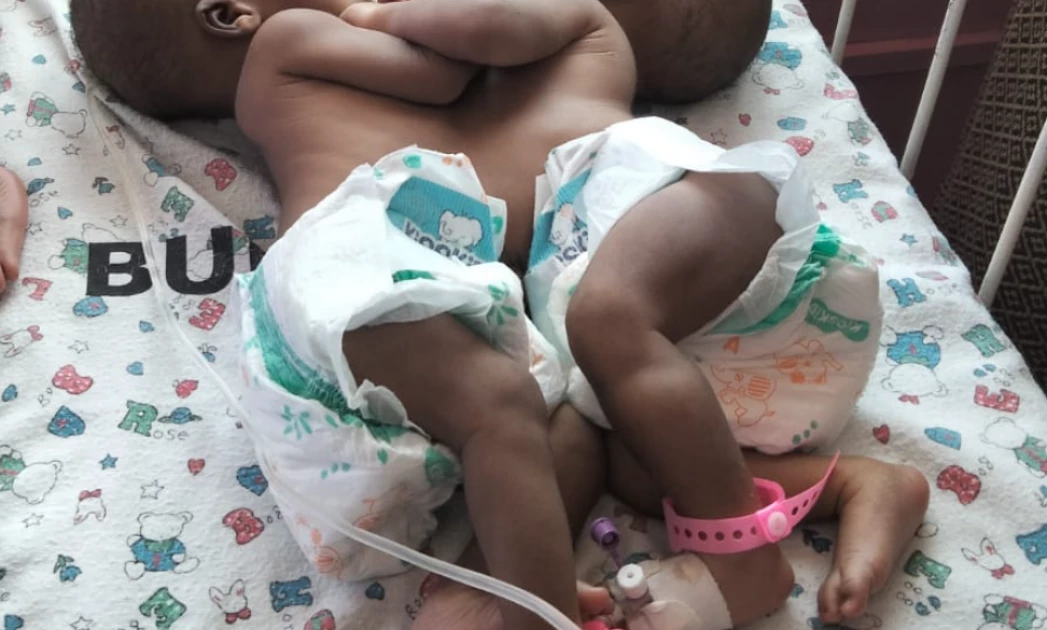 Woman, 25, appeals for help after giving birth to conjoined twins in Bungoma