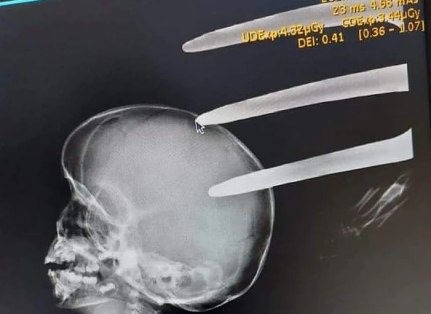 Two-year-old boy who had fork jembe lodged in his head dies at Kenyatta National Hospital