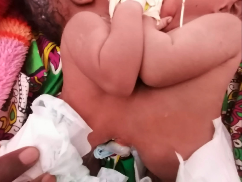 19-year-old woman gives birth to conjoined twins in Kisii